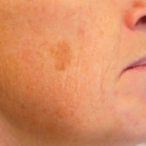 Cryotherapy treatment for brown spots and age spots