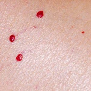 Cryotherapy treatment for cherry angiomas