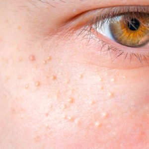 Cryotherapy treatment for milia