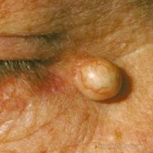 Cryotherapy treatment for sebaceous cysts