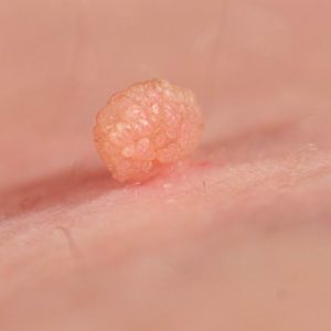 Cryotherapy treatment for skin tags
