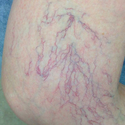 Cryotherapy treatment for spider veins